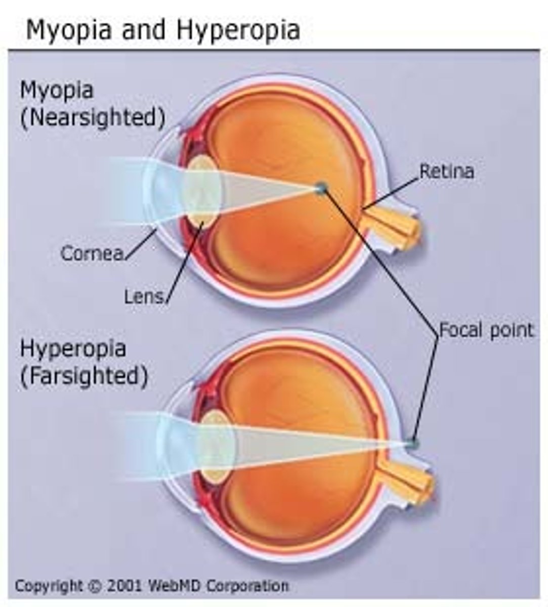 <p>medically known as hyperopia or hypermetropia, is a condition that is the result of the eye's physical inability to focus an image correctly on the retina at the back of the eye. Farsightedness is the result of the eyeball being too short, and/or the lens of the eye not being flexible enough, for proper focus to occur.</p>