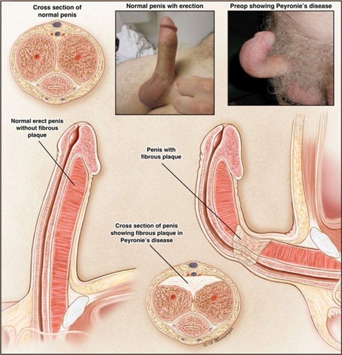 <p>Peyronie disease (connective tissue disorder)</p>