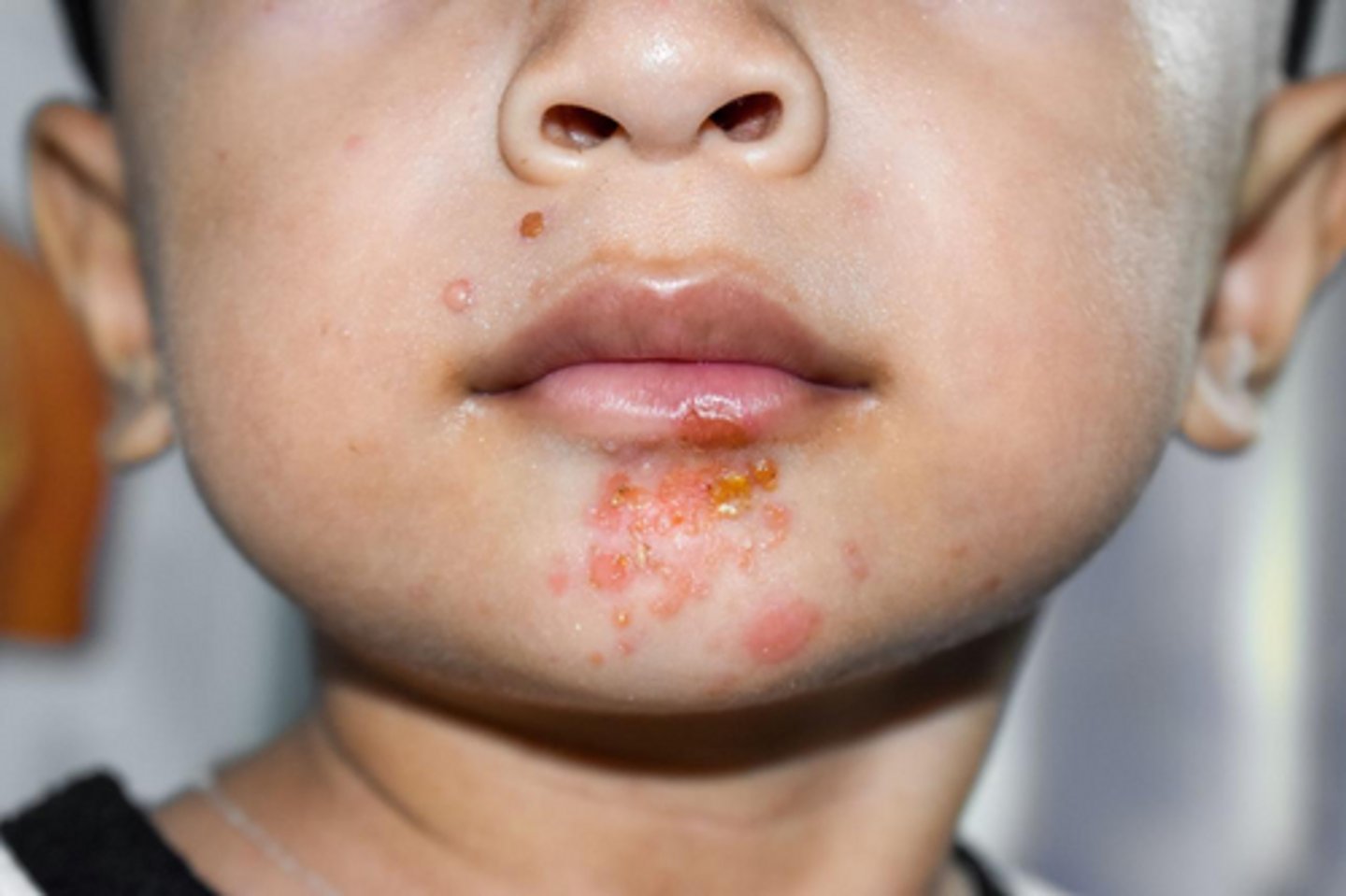 <p>A child presents with yellow, crusted lesions around the mouth. What is the MOST likely diagnosis?</p>