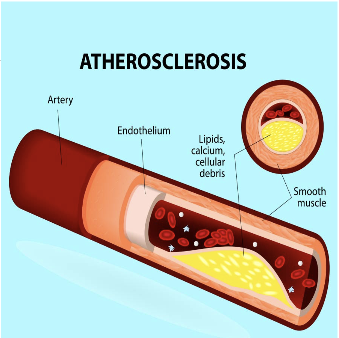 <p>Atherosclerosis </p>