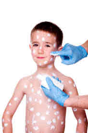 <p>Chickenpox </p>