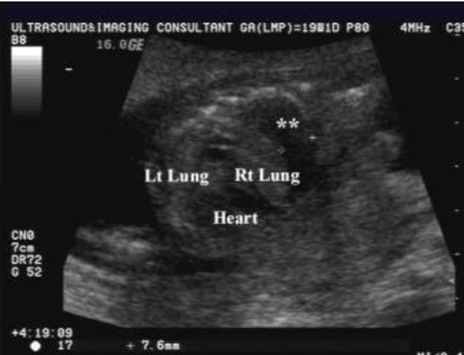 <p>the most common <strong>cause</strong> of <strong>pleural effusion </strong>in a fetus is</p><p>.</p><p>a) <strong>chylothorax</strong> [fluid accumulation in the fetal chest (pleural effusion) that compresses the lungs]</p><p>b) fetal heart failure</p><p>c) polyhydramnios</p><p>d) maternal heart failure</p>