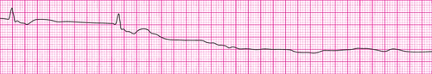<p>Asystole</p>