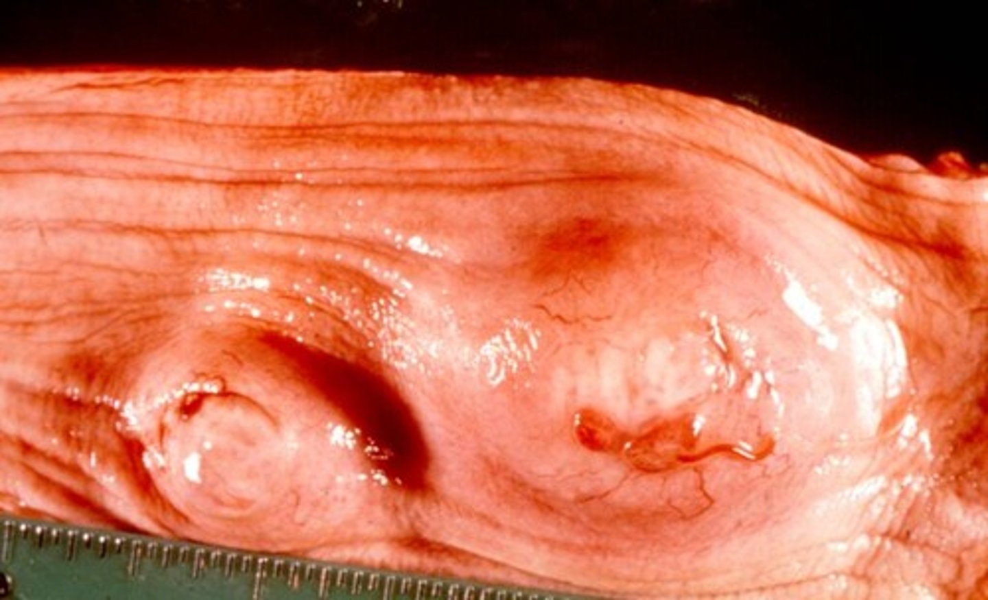 <p>esophageal worm</p><p>osteosarcoma</p><p>tx = ivermectin</p>