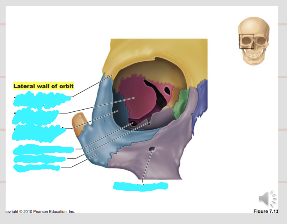 <p>Describe the lateral wall of the orbital cavity</p>