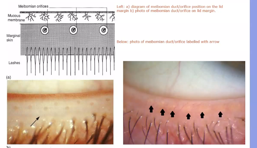 <p>glands exiting at the edge of the lids </p><p>in between the lashes and ocular surface and conjunctiva</p><p>when squeezed, the glands secrete oil </p>