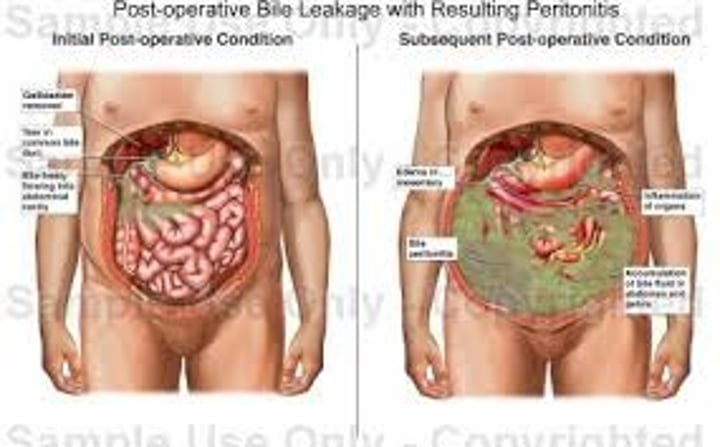 <p>inflammation of the peritoneal cavity<br>- can be a result of infection (peritoneal dialysis)</p>