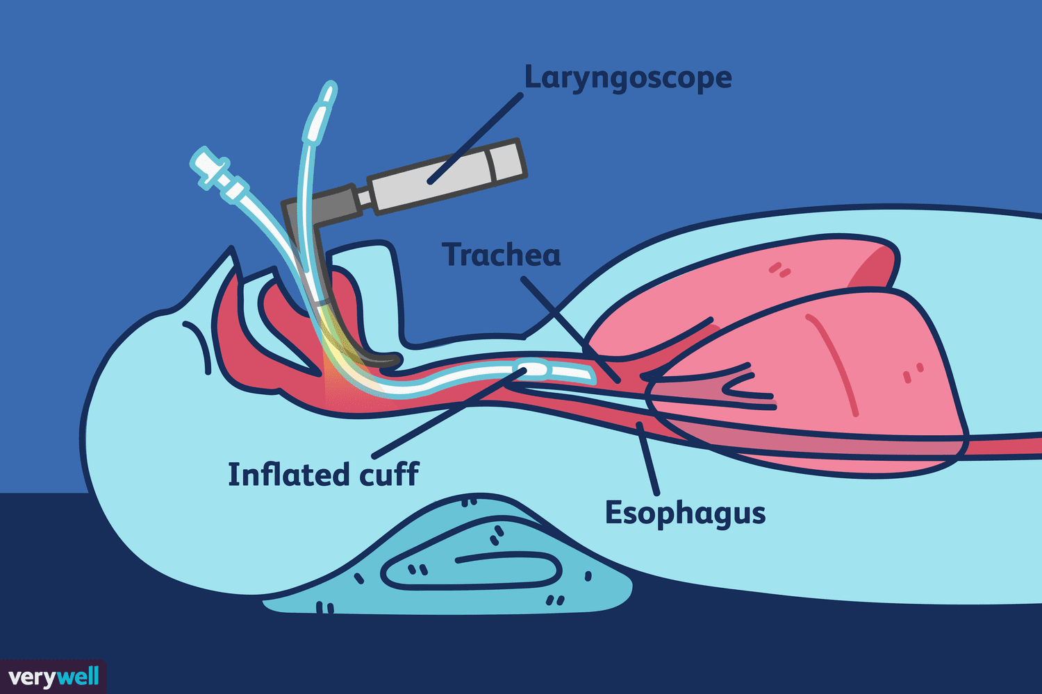 <p><span style="line-height: 107%;"><strong><span>SIMPLE:</span></strong></span></p><p class="MsoNormal"><span style="line-height: 107%;"><span>Intubation means placing a breathing tube into the airway.</span></span></p><p class="MsoNormal"></p>