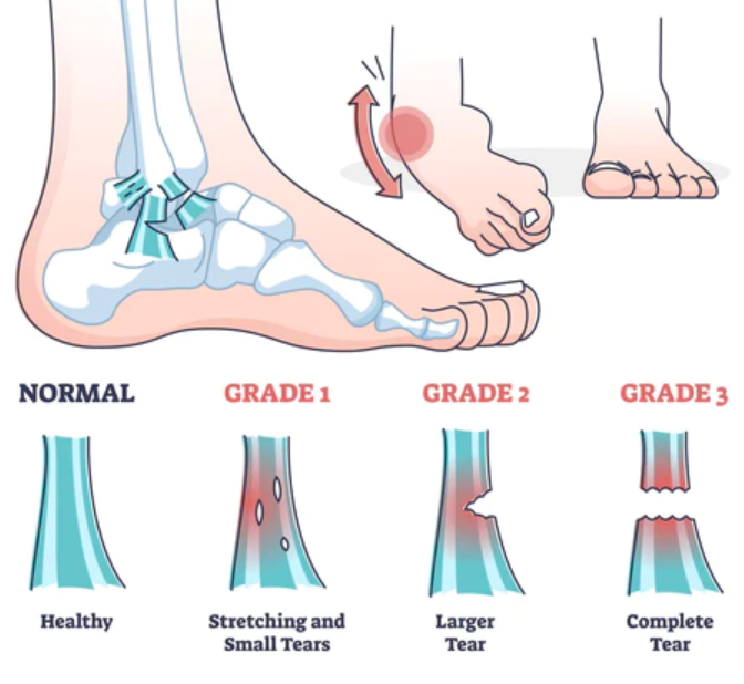 ligaments and/or cartilage reinforcing a joint are stretched or torn (2-3 months to heal d/t poor circulation)
