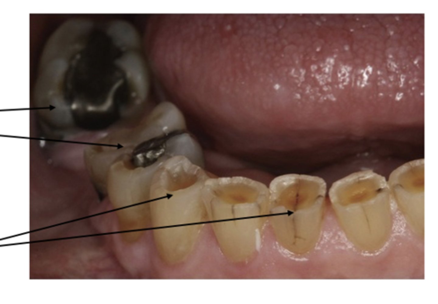 <p>yellow brown dentition</p><p>Bulimia</p><p>Severed acid reflux</p>