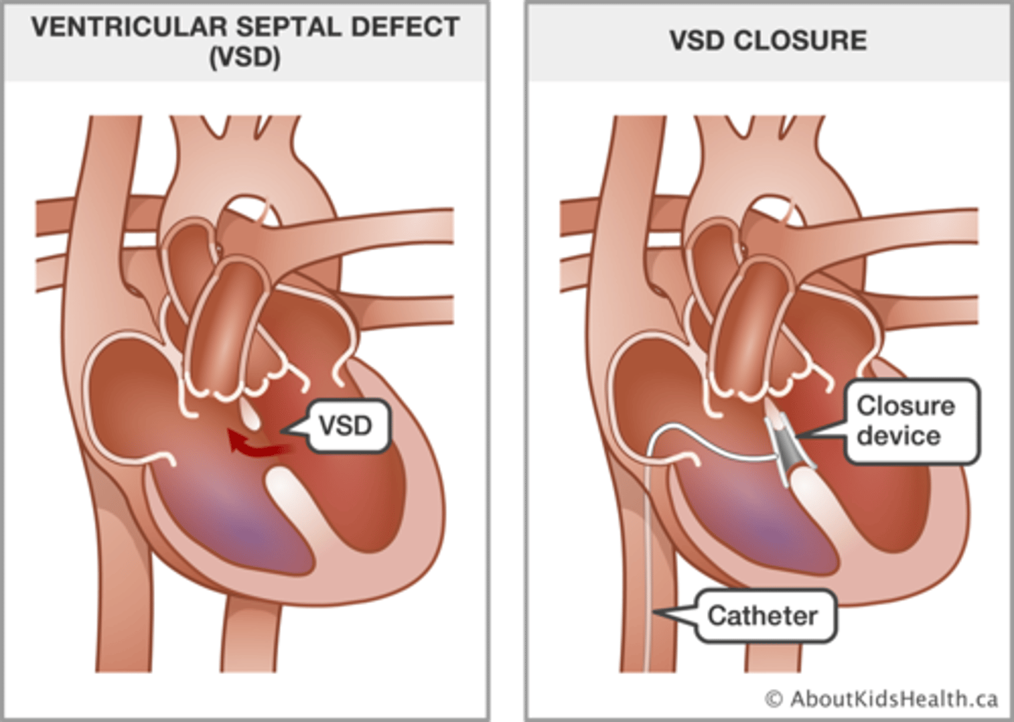 <p>small hole will close on own, Diuretics (for HF) and Surgical repair if severe</p>