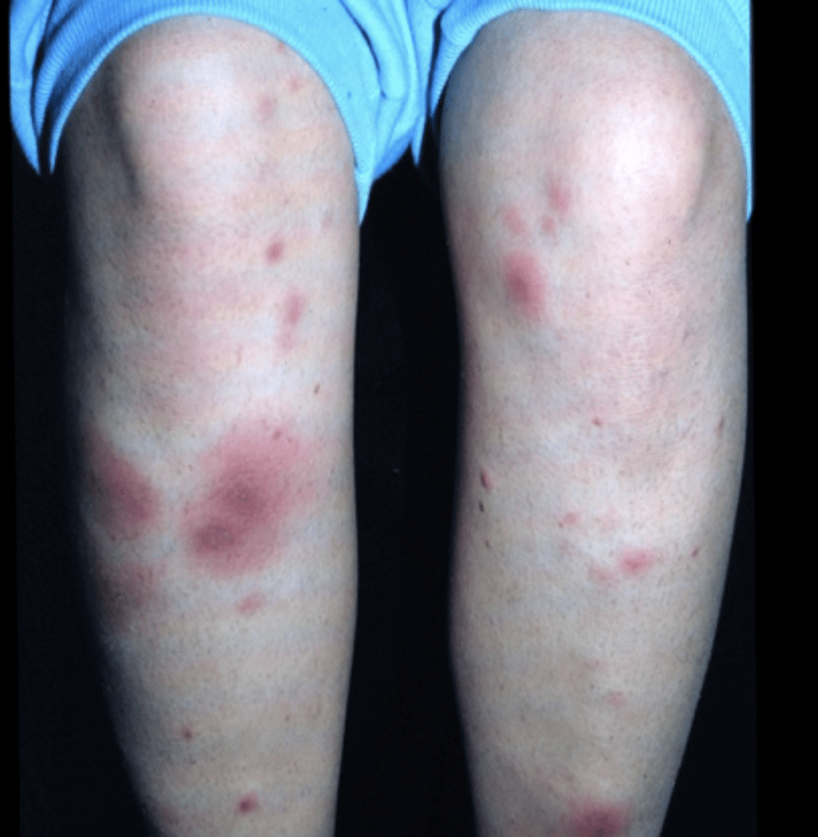 <p>Crohn's disease</p>