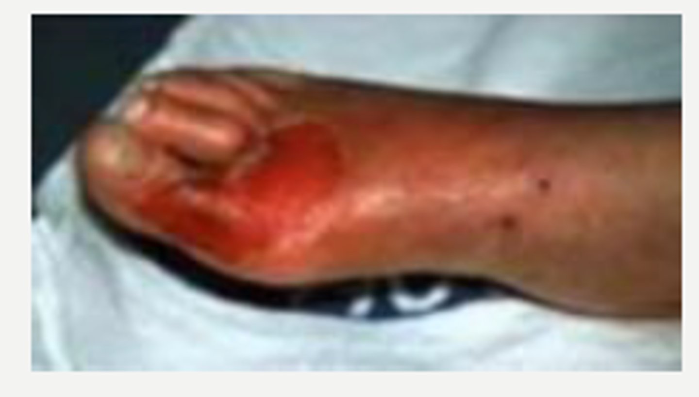 <p>superficial ulceration without penetration to deeper tissue</p>