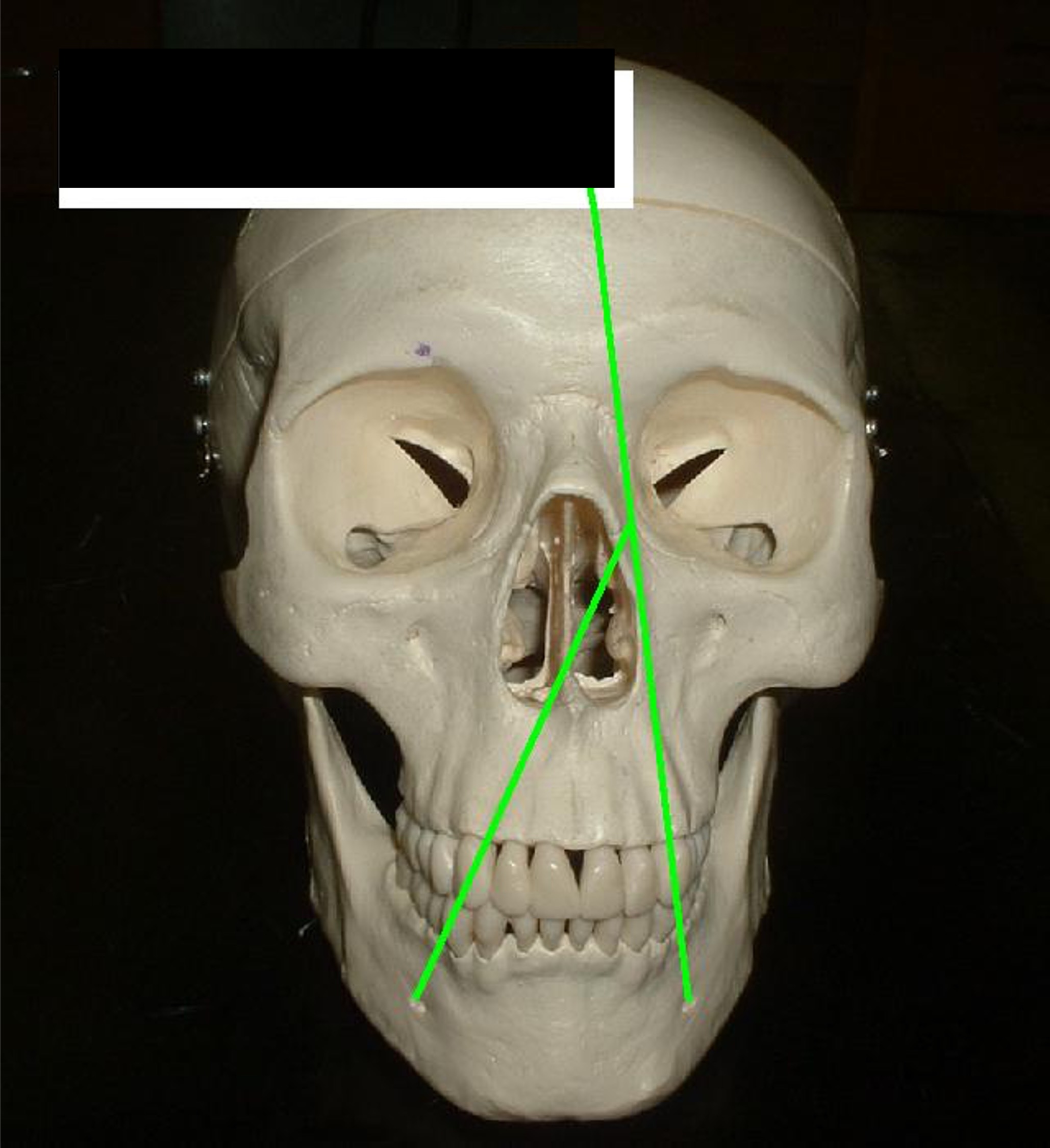<p>small holes (2) in the side of the chin (off center not side of the face)</p>