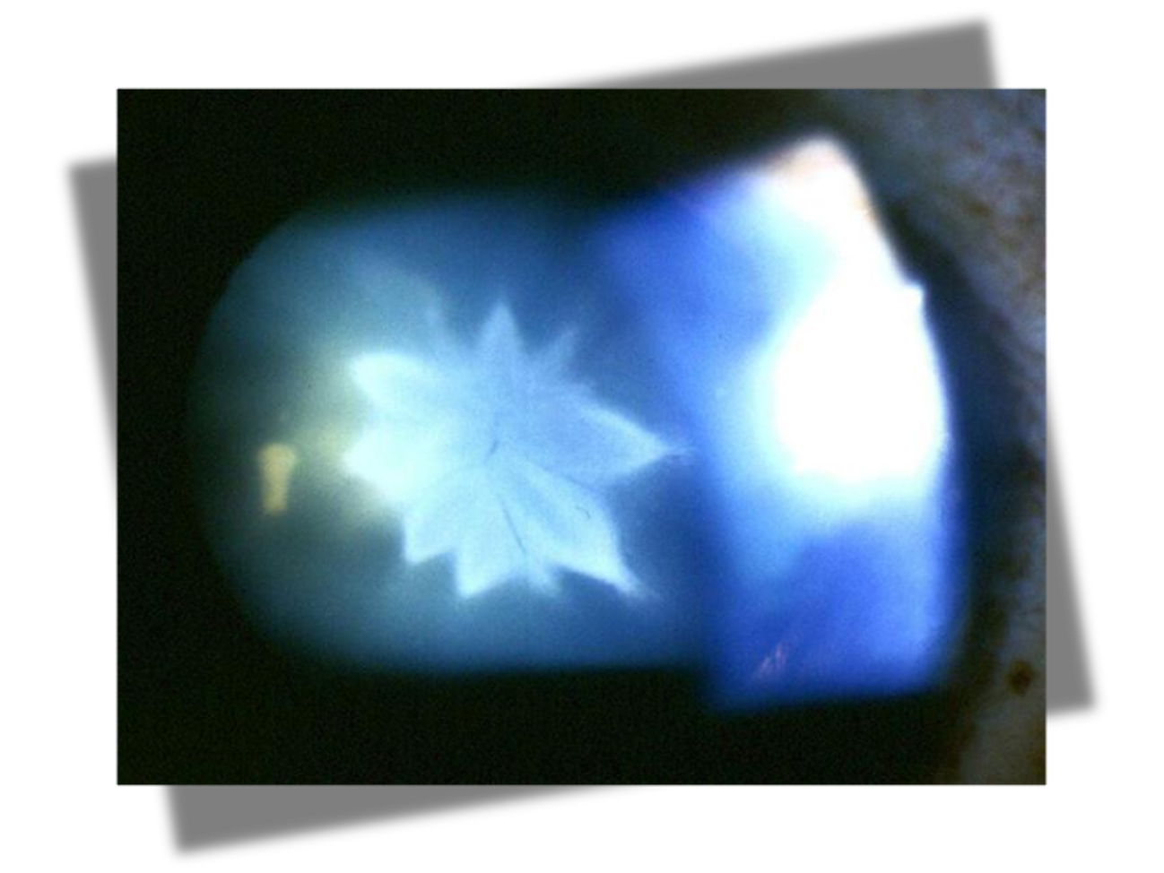 <p>blurred vision secondary to blunt or penetrating ocular trauma; young people</p>
