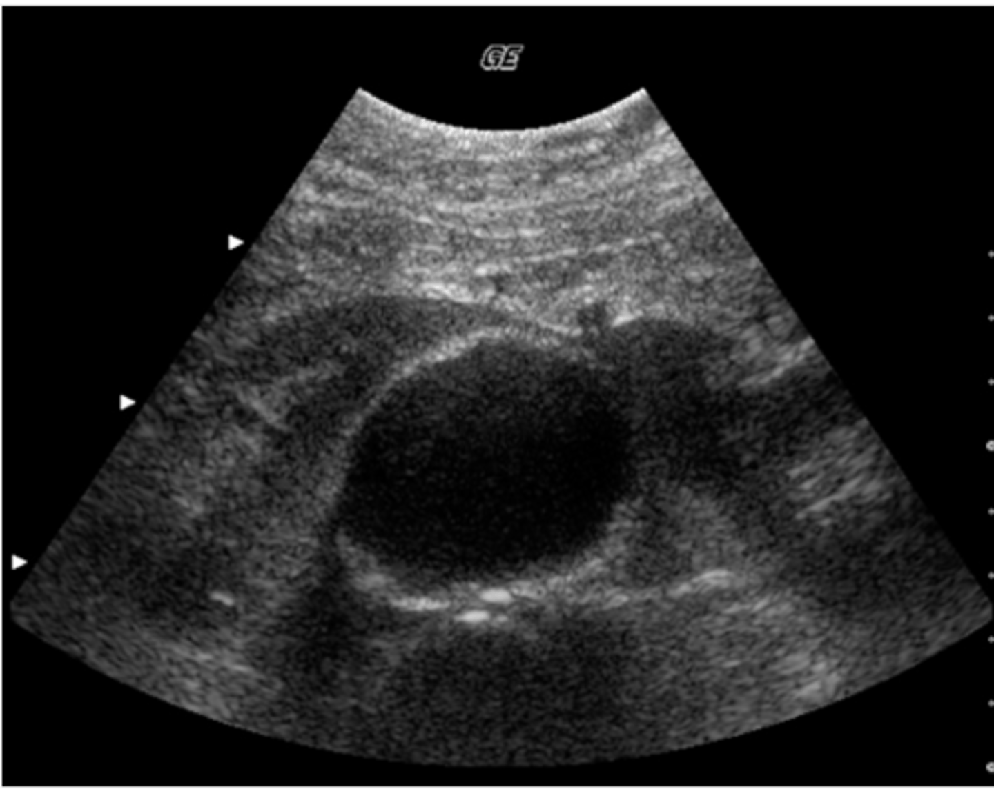 <p>This transverse image was obtained in the mid abdomen of a 57- year-old male with lower back pain. Which of the following correctly describes the sonographic findings?</p><p>a. leaking abdominal aortic aneurysm with hematoma</p><p>b. abdominal aortic aneurysm and para-aortic lymphadenopathy</p><p>c. inflammatory abdominal aortic aneurysm</p><p>d. abdominal aortic aneurysm and horseshoe kidneys</p><p>e. abdominal aortic aneurysm with retroperitoneal fibrosis</p>