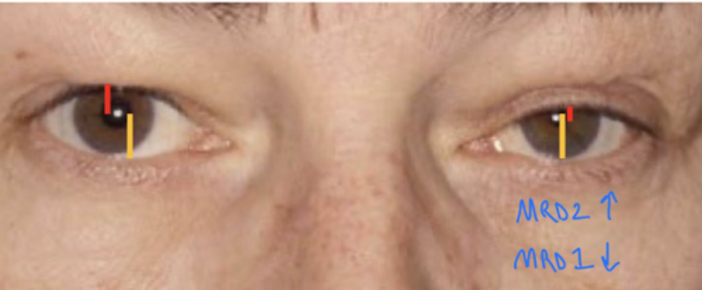<p>two of them</p><p>MRD 1 (red) -- measurement from pupillary reflex to center of upper lid</p><p>MRD 2 (orange) -- measurement from pupillary reflex to center of lower lid</p>