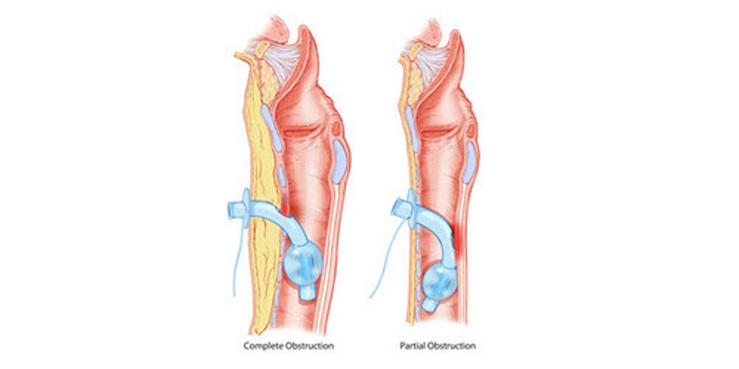 <p>Have holes at the top of the cannula. Allows twisting of the tubes holes to be open or shut.</p><p>Generally avoided now due to risk of granulation forming against or into the fenestration.</p><p>Smaller tubes used instead.</p>