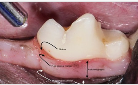 <p>attached and free </p><p></p><p>attached - firmly attached to the underlying periosteum of the alveolar bone</p><p></p><p>free - adopted to the tooth surface</p><p></p><p>at the gingival crevice (sulcus), the cells in the epithelium of the gum adhere to the tooth enamel</p><p></p><p>adherence of the gingiva to the tooth forms a tight seal</p>