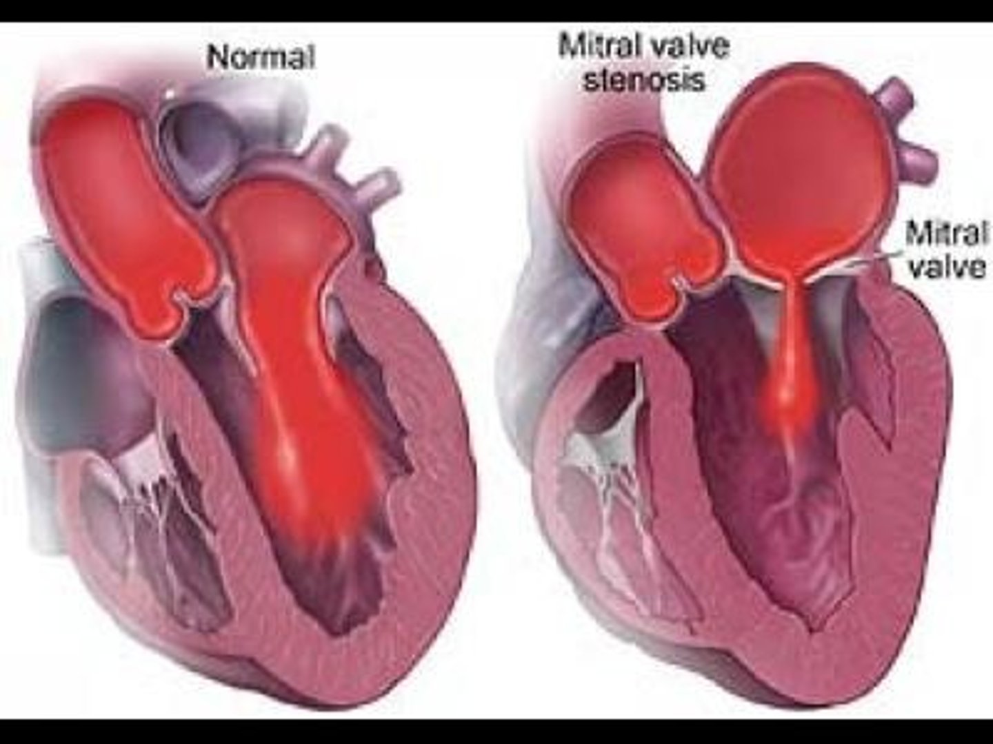 <p>- Majority caused by rheumatic fever</p><p>- Results in decreased blood flow from left atrium to left ventricle</p><p>- Leads to increased left atrial pressure and increased pulmonary pressure; risk for atrial fibrillation</p><p>- S/S: exertional dyspnea, loud S1, fatigue, palpitations, hoarseness, hemoptysis, chest pain, stroke</p>