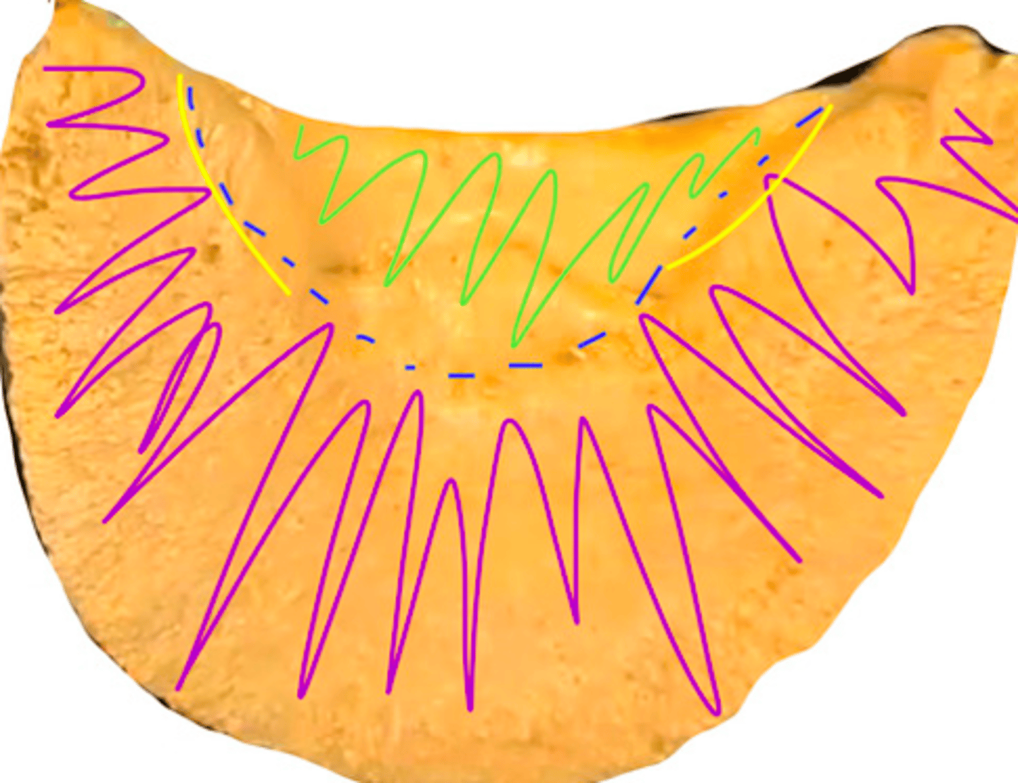 <p>this is the sole of the distal phalanx. the line in blue is called</p>