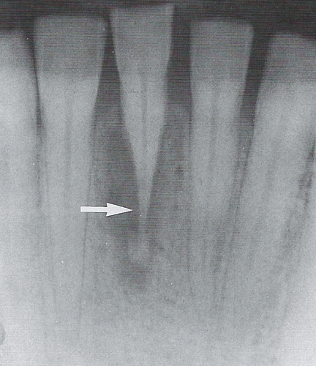 <p>arise from the tissue outside the tooth, such as PDL</p>