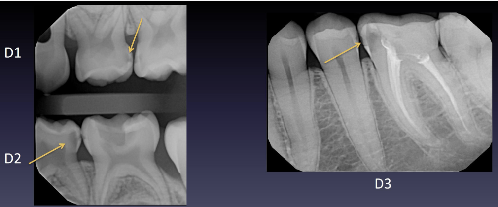 <p>Interproximal Lesion Examples</p>