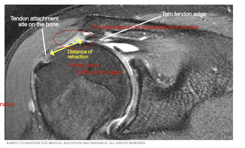 <p>Rotator Cuff Tears: S/S</p><ul><li><p>4 main S/S:</p></li></ul><p></p><p></p>