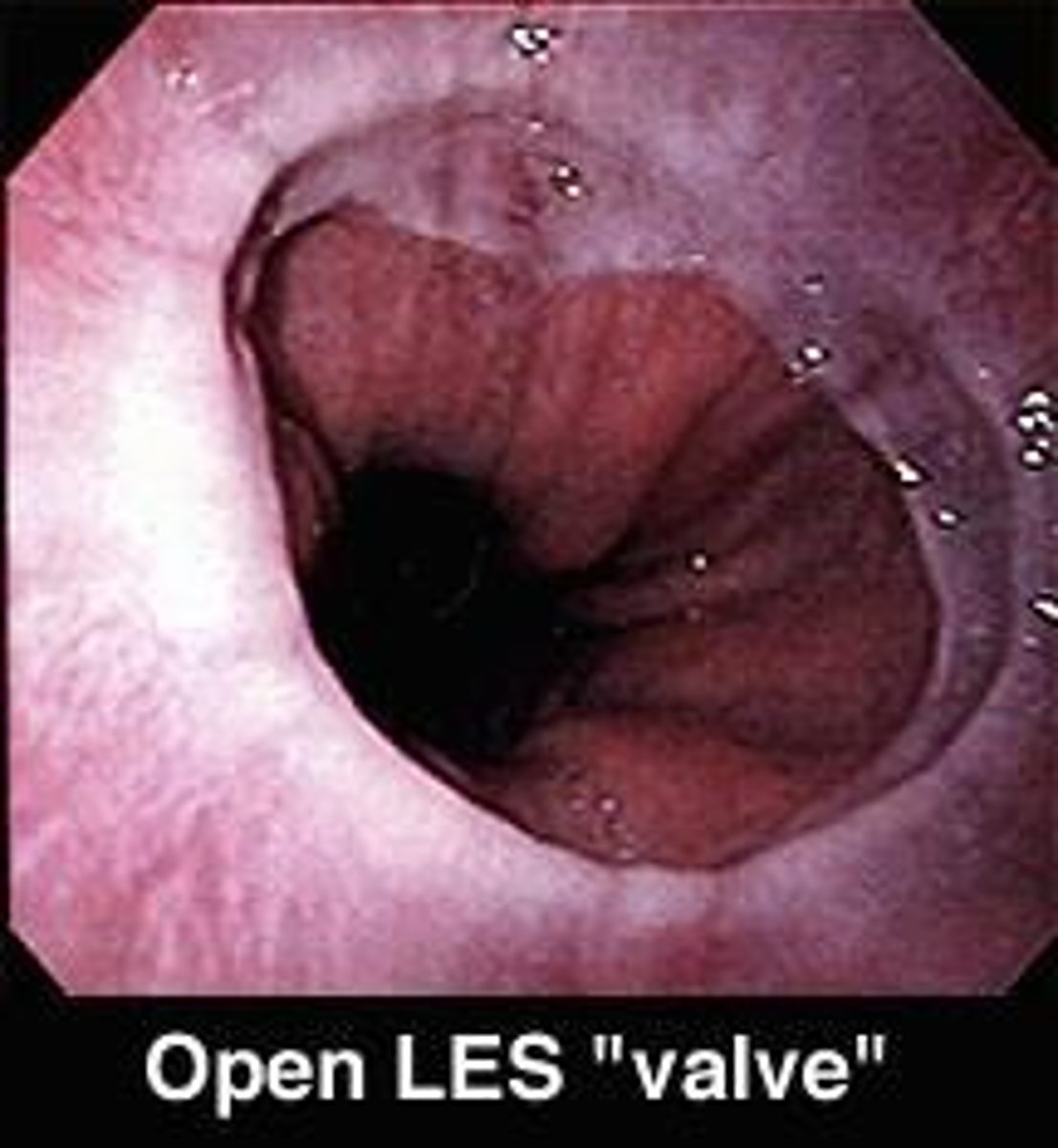 <p>GERD is a condition characterized by lower esophageal sphincter malfunction, allowing gastric contents to flow backward into the esophagus.</p>