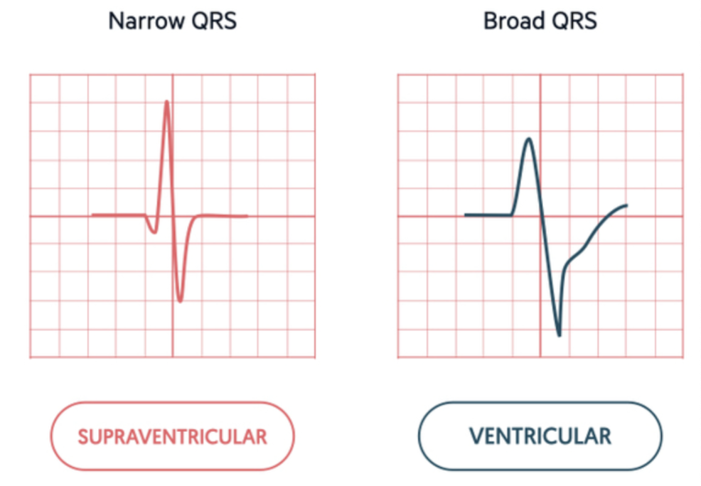 <ul><li><p><strong>Narrow </strong></p><ul><li><p>A supra-ventricular focus </p></li></ul></li><li><p><strong>Wide</strong></p><ul><li><p>A ventricular pacemaker or a supra-ventricular pacemaker that was delayed </p></li></ul></li></ul><p></p>