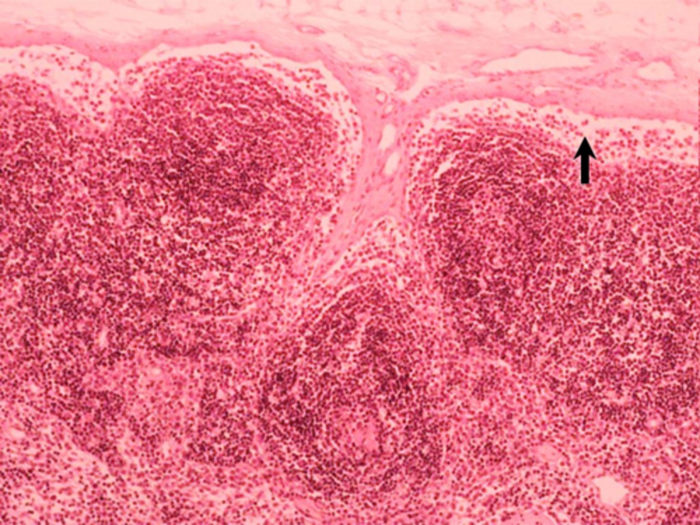 <p>black arrow</p><p>subcapsular sinus</p>
