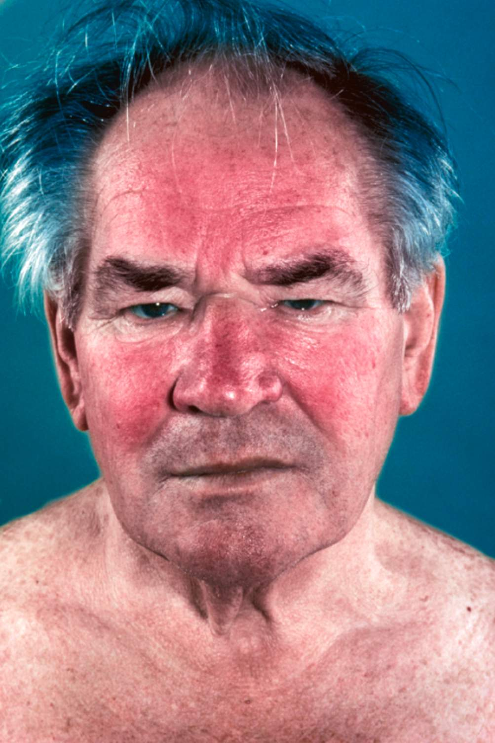 <ul><li><p><span>Sign of <strong>mitral stenosis </strong></span></p><ul><li><p><span>causes decreased cardiac output and pulmonary hypertension </span></p><p><span>→ dilatation of the blood vessels in the cheeks giving them a dusky red or purple colour</span></p></li></ul></li></ul><img src="https://cardioblogger.com/wp-content/uploads/2023/10/mitral-valve-stenosis.png" data-width="100%" data-align="center" alt=""><p><a target="_blank" rel="noopener" class="Hnk30e indIKd link" href="https://cardioblogger.com/mitral-stenosis-symptoms-and-clinical-assessment/" data-prevent-progress="true"><br></a></p>