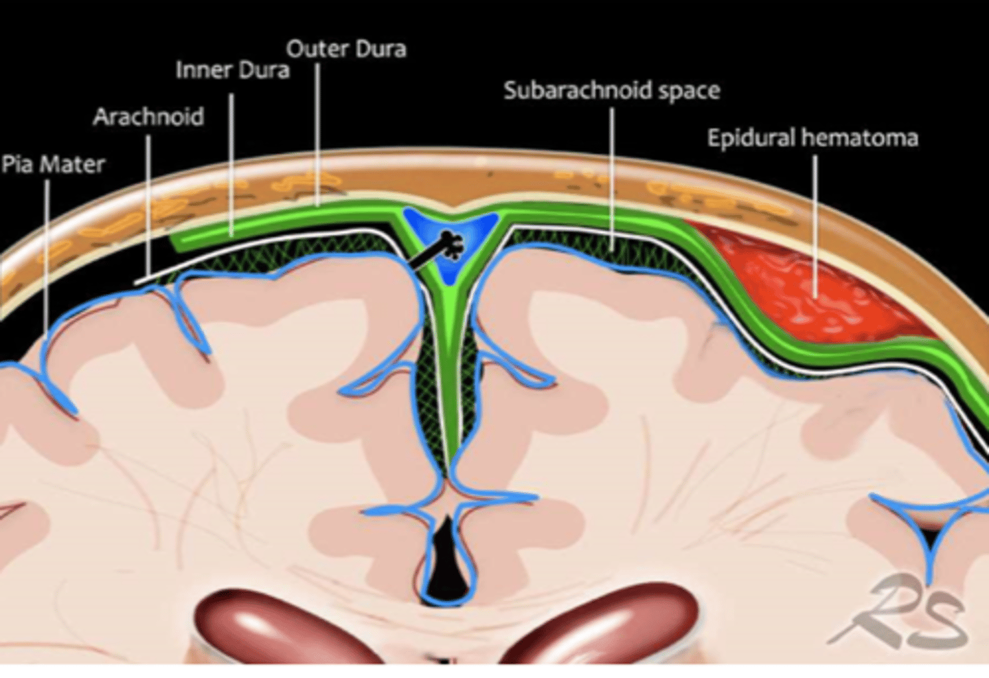<p>bleeding in potential space <strong>between skull and dura matter</strong></p><p>-often occurs with <span class="bgP">fracture of temporal bone</span> with tearing of the <strong>middle meningeal artery</strong></p><p>-appears convex lens-shaped on head imaging</p><p>-Lucid interval - initially symptoms, improves, deterioration</p>