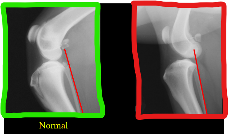 <ul><li><p><strong>Cause</strong></p><ul><li><p>Young <strong>athletic</strong> (acute) <strong>or fat dogs</strong> (chronic)</p></li><li><p>degeneration, separation, weaking of the lig</p></li></ul></li><li><p><strong>CS</strong></p><ul><li><p>Non weight bearing lameness, patellar luxation</p></li></ul></li><li><p><strong>RS</strong></p><ul><li><p>cranial tibia displacement, <strong>“Rad Drawer sign</strong>”, Intracapsular <strong>swelling </strong>squishing fat pad, joint mice from <strong>evulsion </strong>fracture, <strong>swelling of the medial joint capsule (medial butrus),</strong> osteoarthritis</p></li></ul></li></ul><p></p>
