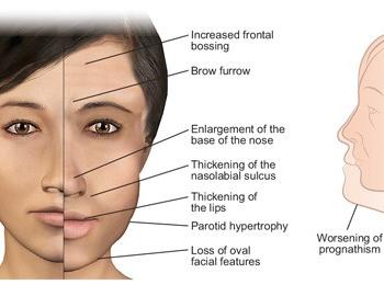acromegaly 