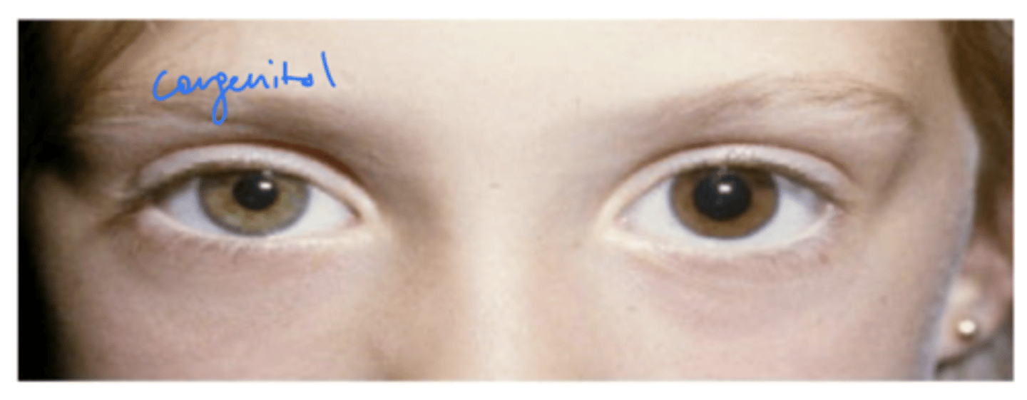 <p>congenital -- color change of the iris</p><p>cannot tell if it is blue eyes</p>