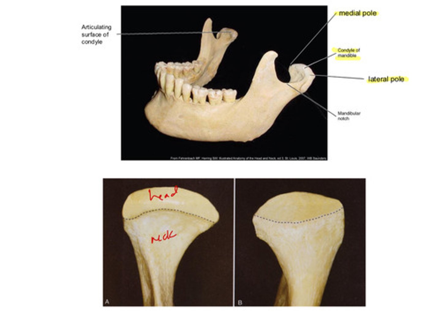 <p>1) articulating surface of condyle</p><p>2) condyle of mandible (head and neck)</p><p>3) medial pole of condylar process</p><p>4) lateral pole of condylar process</p><p>5) mandibular notch</p>
