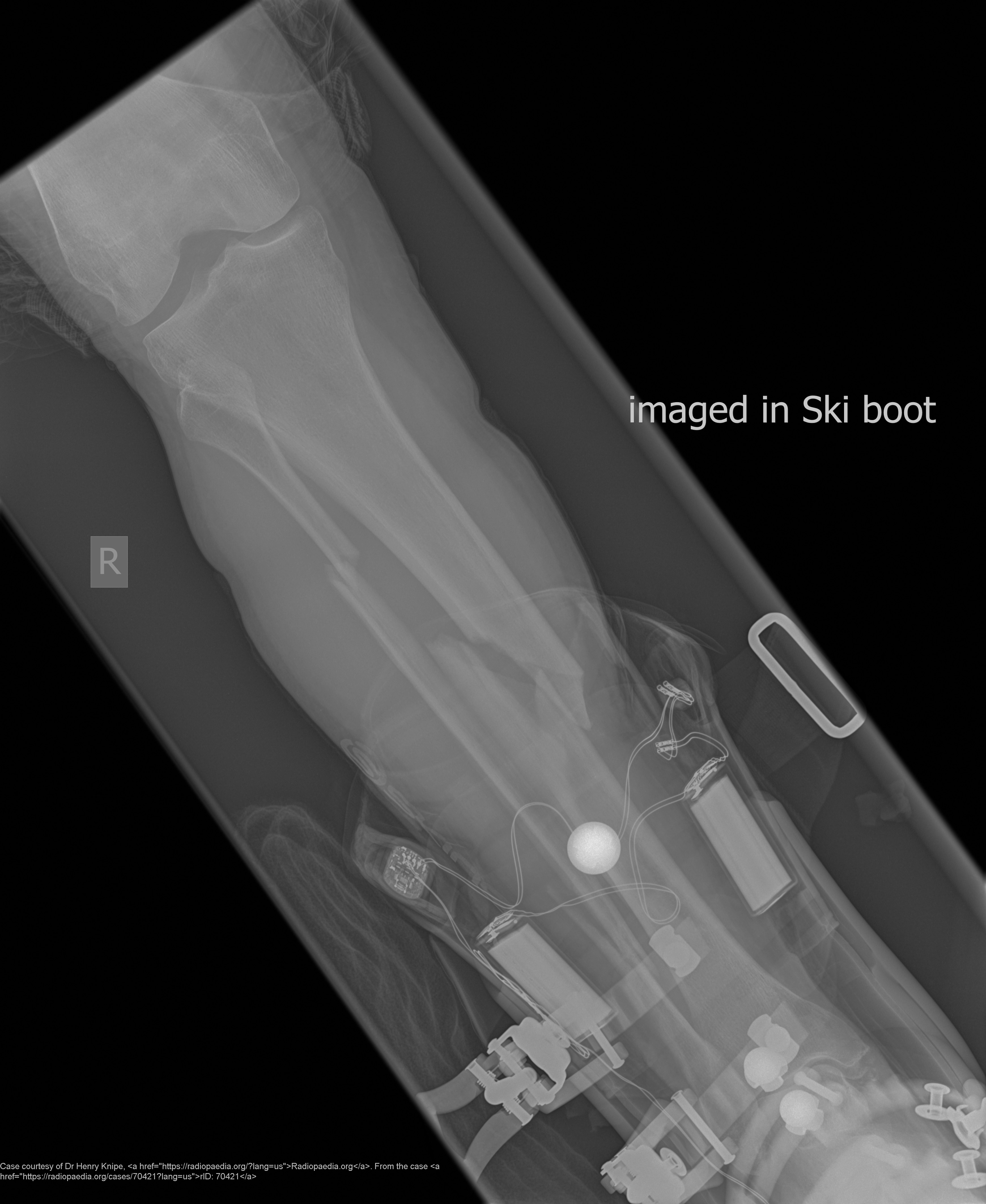 <p>Skiing or direct leg trauma.</p>