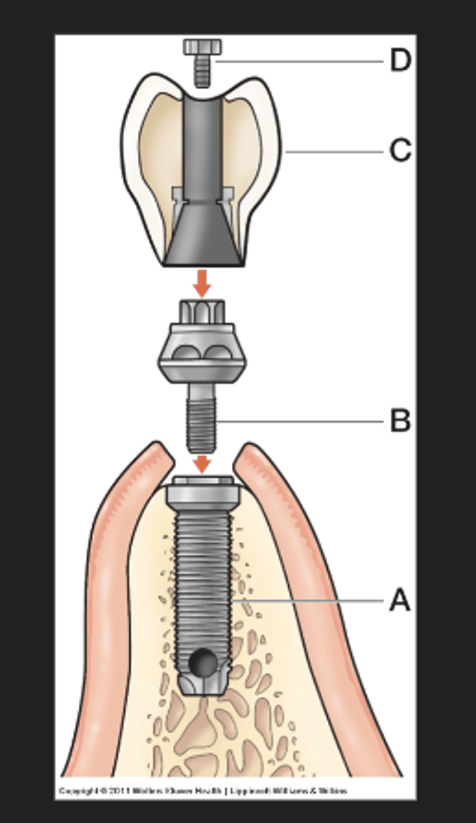 <p>body, abutment, prosthesis, and screw</p>
