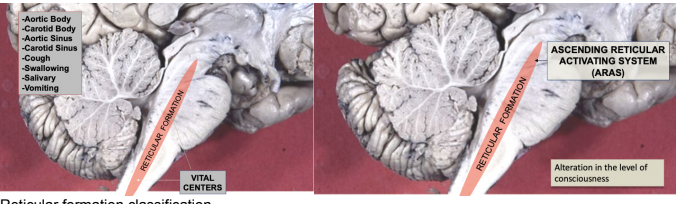 <ul><li><p>Oldest part of the brain — diffuse, multisynaptic, netlike meshwork (reticulum) of widely interconnected neurons in the tegmentum</p></li><li><p>Due to it being the phylogenetically oldest, — functions to support ex. survival of the individual — has to do with the <u>vital centers</u> of the brainstem</p></li><li><p>Involved in nearly every aspect of brain function including homeostasis, consciousness, arousal (waking up), pain, primitive motor control (descending motor pathways from RF), muscle tone (function of final reticular descending pathway &amp; vestibulus final descending pathway) and behavioral mechanisms </p></li><li><p>Vital centers are located in the medulla &amp; pons and control cardiovascular, respiratory, and other homeostatic mechanisms — lesions here are fatal</p></li><li><p>Ex. of reticular formation mediated reflexes:</p><ul><li><p>Aortic body, carotid body, aortic sinus, carotid.sinus, cough, swallowing, salivary, &amp; vomiting</p></li></ul></li><li><p>Most rostral part of the reticular formation (in midbrain) — involved in beforementioned mechanisms (ex. pain control) — but not respiration or cardiovascular control — due to this part mostly concerning bombarding of cerebral cortex with a lot of excitatory inputs —</p></li><li><p>Midbrain reticular formation gives rise to a tonic ascending barrage of diffuse, non-specific sensory data calld the <u>ARAS</u> (ascending reticular activating system)</p></li><li><p>Reticular formation extends in the midbrain, pons, medulla, &amp; also cervical segment of spinal cord</p></li></ul>