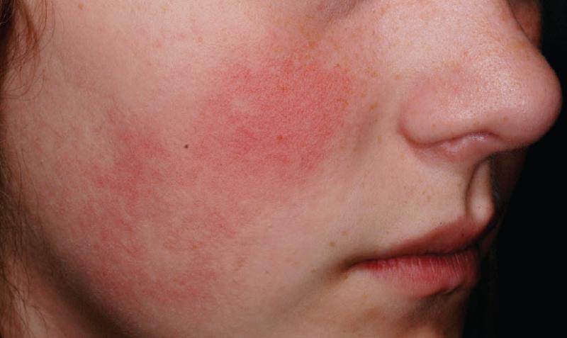 <p>Burns or clogged blood vessels (<strong>erythema</strong>) </p>