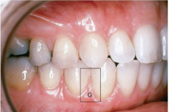 <p>Pointed part of gingiva located between the teeth</p>