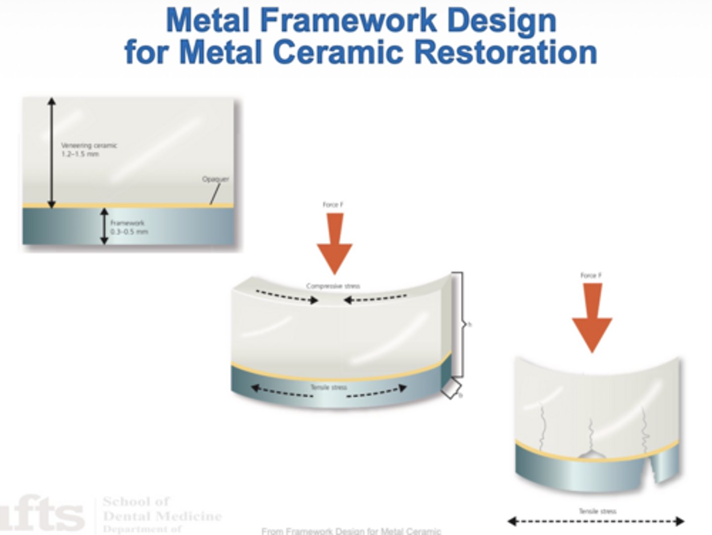 <p>B) Tension stresses -- that is why we have a metal collar on the lingual surface</p>