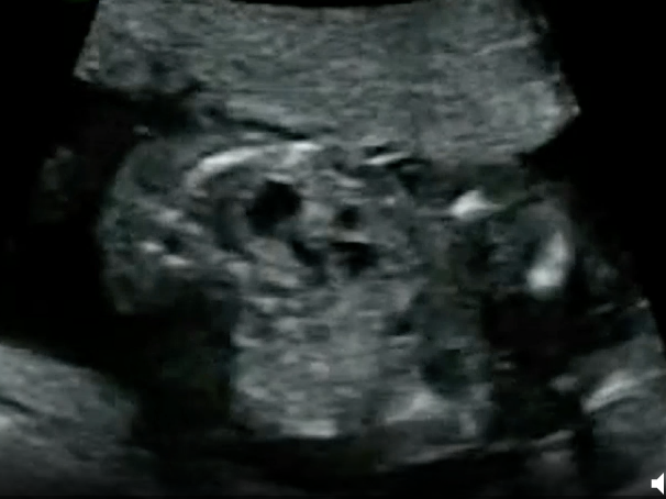 <p>encephalocele  + polydactylyl is noted. these findings are most suggestive of</p><p>a) trisomy 13</p><p>b) meckel gruber syndrome</p><p>c) trisomy 18</p><p>d) turner syndrome </p>