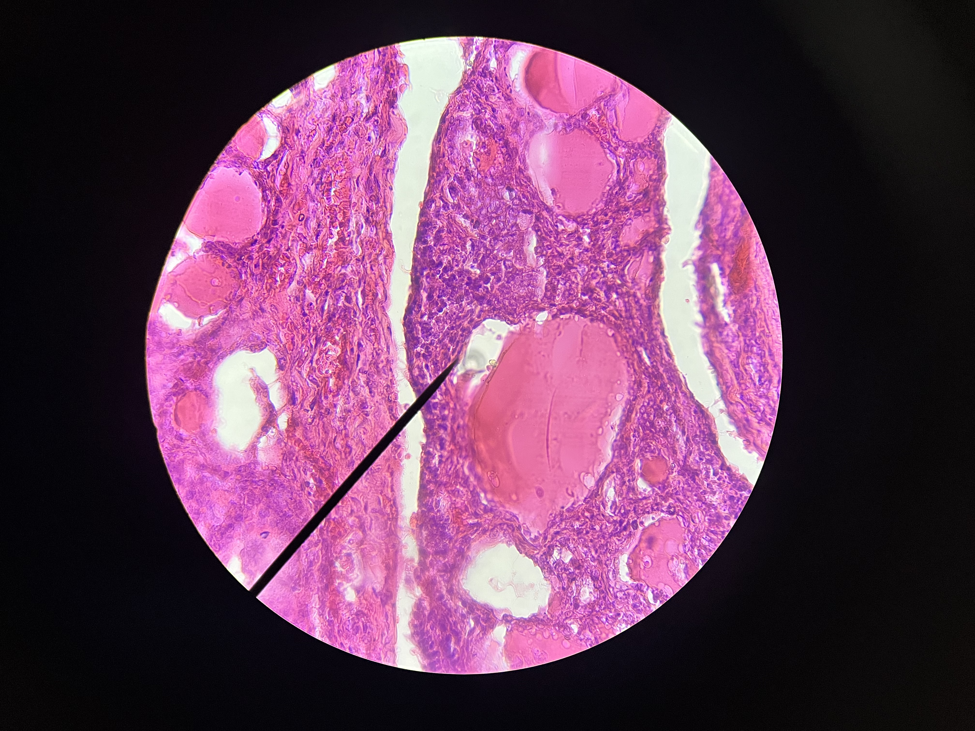 <p>Known for its histomorphologic feature as the “Orphan Annie eye”  </p>