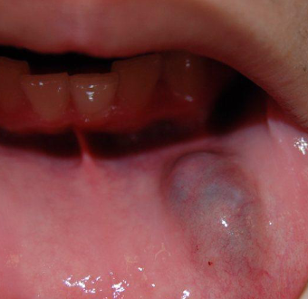 <p>most common on lower lip due to trauma of minor salivary gland </p>