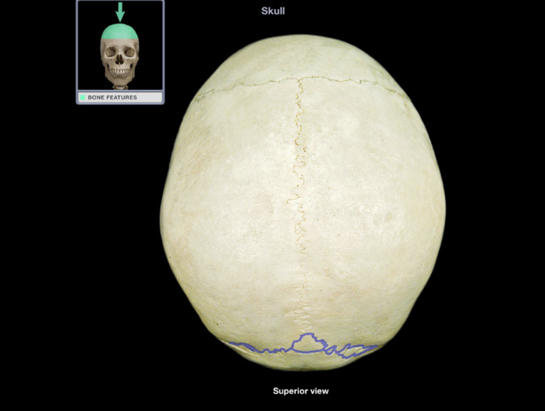 <p>Lambdoid suture</p>