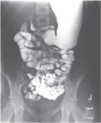 <p>Small Bowel at 1 Hour: Is this Image Good?</p>