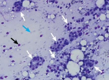 <p>Lymph node cytology</p><p>Enlarged lymph nodes - disease</p><p>Submandibular lymph node was enlarged and underwent FNA - what can we see here?</p><p>DX?</p>