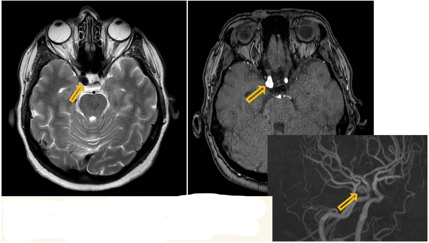 <p>Patient history: young asymptomatic patient with positive family history of cerebral aneurysm </p><p>Modality: T2W MRI and 3D TOF angiography (noncontrast) </p><p>Region: brain, axial view</p><p> Radiologic sign: circumscribed, larger “flow-void” on T2W MRI and dilatation of the right internal carotid artery on TOF (yellow arrow) </p><p>Diagnosis: aneurysm of the right internal carotid artery (cavernous part)</p>